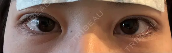 二重埋没 9BeautyClinic DAY 0 メイン用