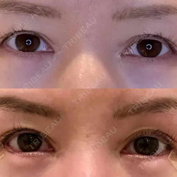 目尻切開 / タレ目形成・グラマラスライン（埋没） LOUIS CLINIC 二子玉川院【ルイクリニック】 DAY 6 メイン用