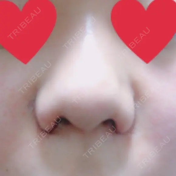 小鼻縮小（切開） ヴェリィ美容形成クリニック DAY 1 メイン用