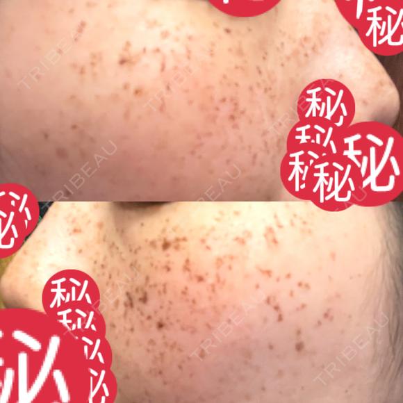 ルメッカ MIO CLINIC 梅田院 DAY 5 メイン用
