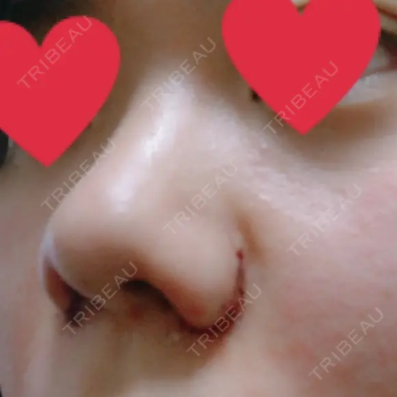 小鼻縮小（切開） ヴェリィ美容形成クリニック DAY 1 メイン用