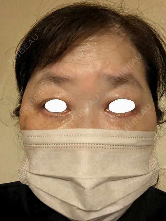 下まぶたたるみ取り / 下まぶたの脂肪取り / 脂肪注入（目の下） アリエル美容クリニック 郡山院 DAY 35 メイン用