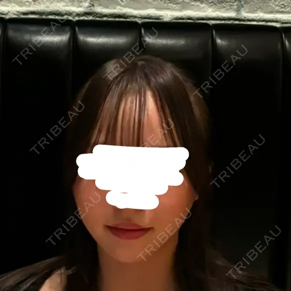 糸リフト / 脂肪吸引（顔） / ジョールファット除去 / ヒアルロン酸注入（あご） SEA CLINIC（シークリニック） AFTER メイン用