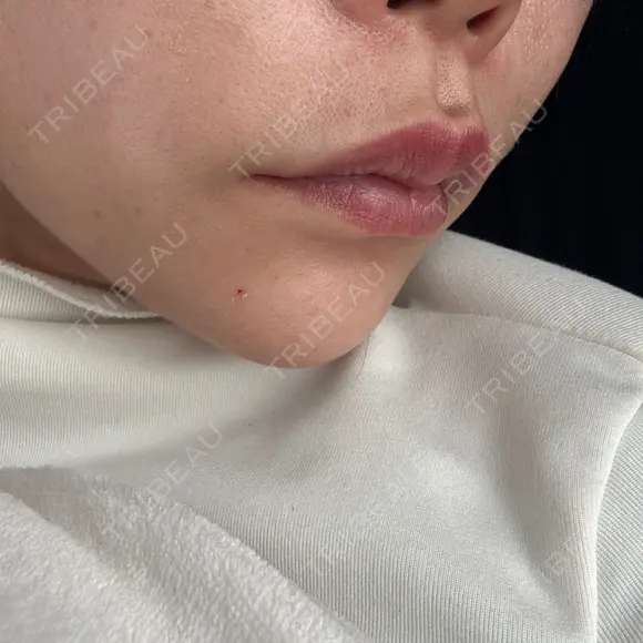 ヒアルロン酸注入（鼻翼基部） ルラ美容クリニック 大宮院 / ルラスキンクリニック 大宮院 DAY 14 メイン用