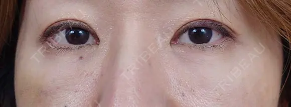 下まぶたたるみ取り / 下まぶたの脂肪取り / 脂肪注入（目の下） 湘南美容クリニック 千葉センシティ院 DAY 13 メイン用