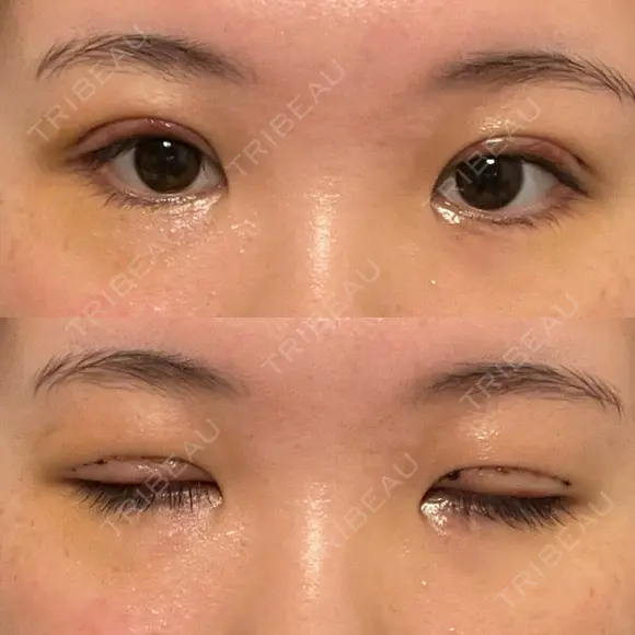 二重切開 / 眼瞼下垂（切開） / 上まぶたたるみ取り ユア美容クリニック 福岡院 DAY 5 メイン用