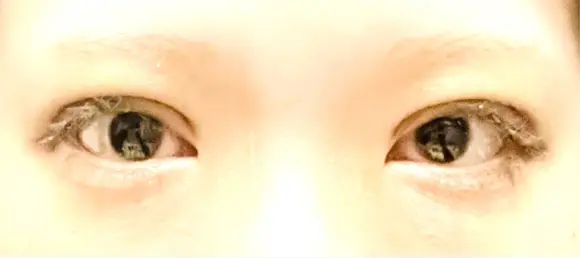 二重埋没 / 上まぶたの脂肪取り / ボトックス（額） 9BeautyClinic DAY 7 メイン用