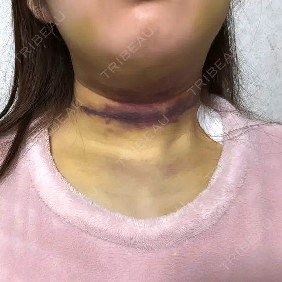 脂肪吸引（顔） TCB東京中央美容外科 新横浜院 AFTER メイン用