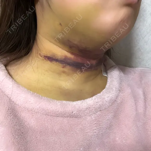 脂肪吸引（顔） TCB東京中央美容外科 新横浜院 DAY 7 メイン用