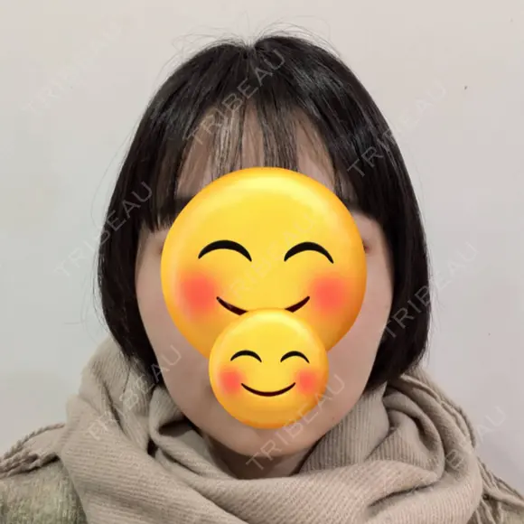 骨削り（エラ） / 脂肪吸引（顔） id（アイディ）美容外科 AFTER メイン用