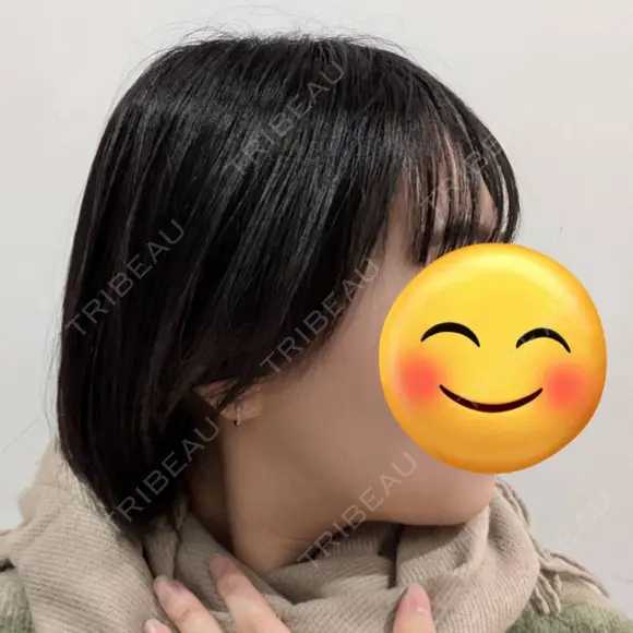 骨削り（エラ） / 脂肪吸引（顔） id（アイディ）美容外科 DAY 366 メイン用