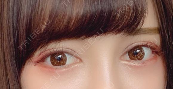 二重切開 / 眼瞼下垂（切開） / 目尻切開 / タレ目形成・グラマラスライン（切開） / ヒアルロン酸注入（涙袋） ジュエリー美容外科 DAY 10 メイン用