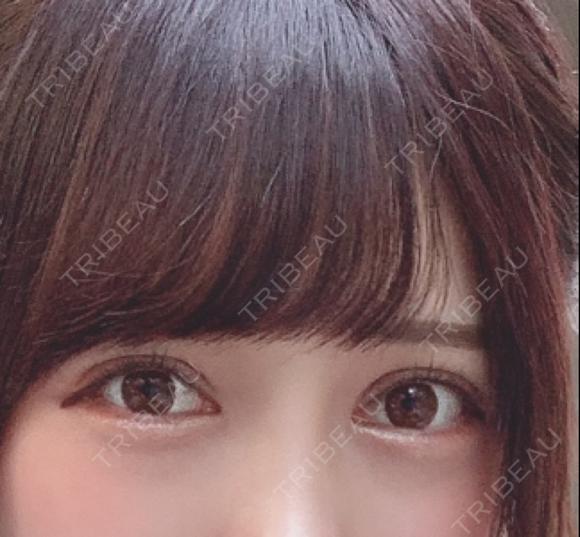 二重切開 / 眼瞼下垂（切開） / 目尻切開 / タレ目形成・グラマラスライン（切開） / ヒアルロン酸注入（涙袋） ジュエリー美容外科 DAY 13 メイン用