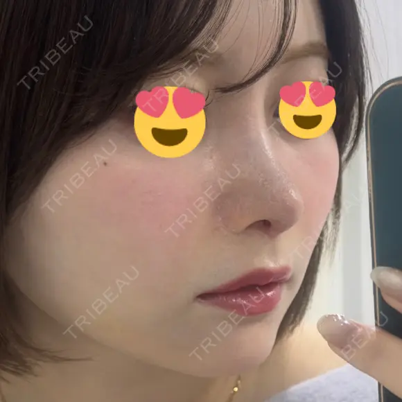 隆鼻術 / 鼻尖形成（切開） / 鼻中隔延長（切開） / 軟骨移植 / 鼻修正 / 鼻尖縮小 / 真皮移植 / 小鼻縮小（非切開） 銀座マイアミ美容外科 DAY 12 メイン用