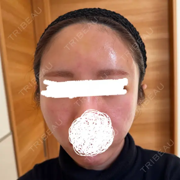 脂肪注入（額） EMMA CLINIC（エマクリニック） DAY 6 メイン用