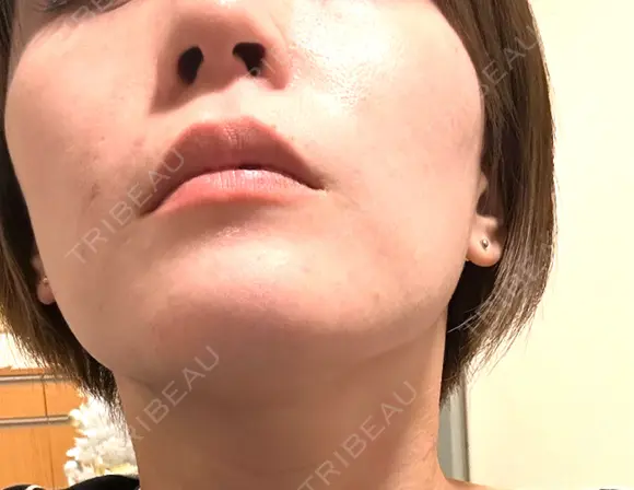 糸リフト / 脂肪吸引（顔） Wing clinic 豊中駅前院 AFTER メイン用
