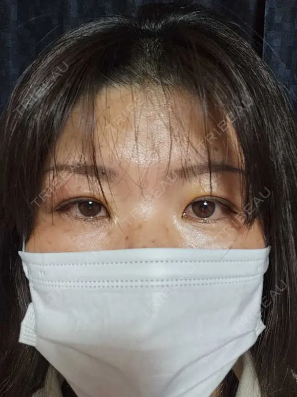 二重埋没 湘南美容クリニック 千葉センシティ院 DAY 3 メイン用