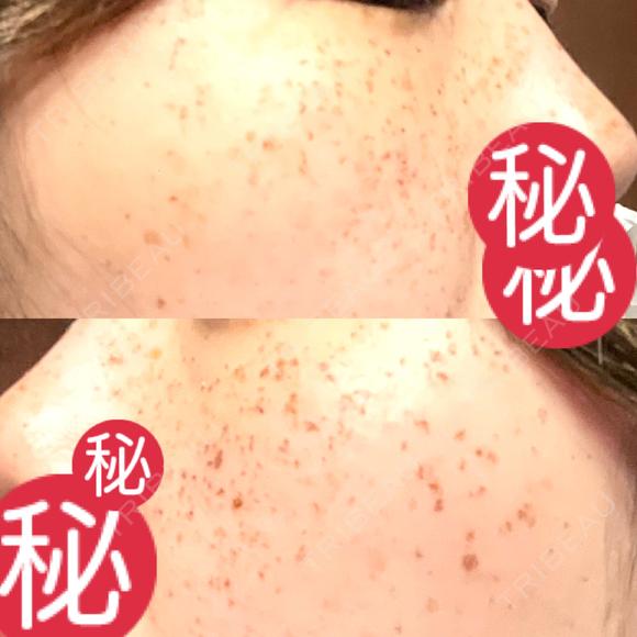 ルメッカ MIO CLINIC 梅田院 DAY 7 メイン用