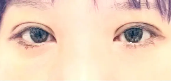 二重埋没 / 上まぶたの脂肪取り / ボトックス（額） 9BeautyClinic DAY 8 メイン用
