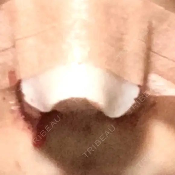 鼻尖形成（切開） / 小鼻縮小（切開） / 眉間プロテーゼ 東京シンデレラ美容外科 池袋院 DAY 1 メイン用