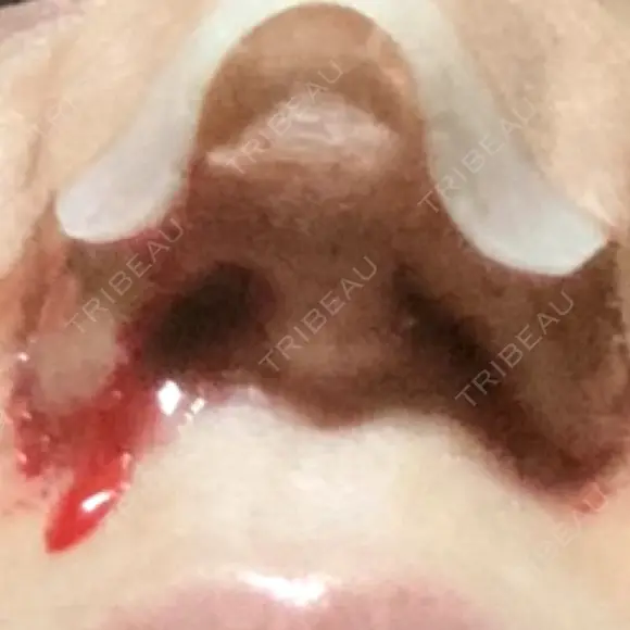 鼻尖形成（切開） / 小鼻縮小（切開） / 眉間プロテーゼ 東京シンデレラ美容外科 池袋院 DAY 1 メイン用