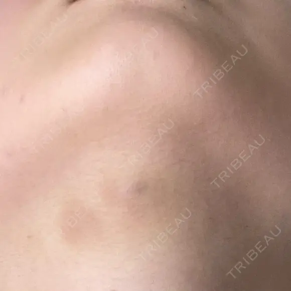 脂肪溶解注射（顔） / ルメッカ ブルームクリニック（BLOOM CLINIC） DAY 3 メイン用