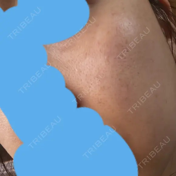 リジュラン ミニマムスキンクリニック池袋 DAY 7 メイン用