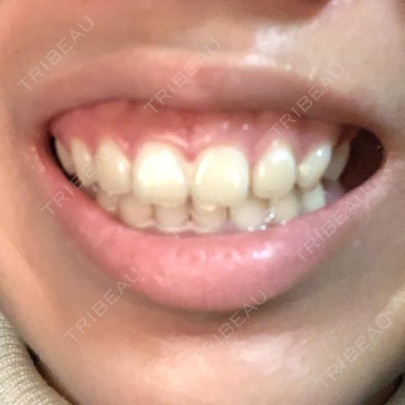 ガミースマイル手術 有楽町美容外科クリニック DAY 0 メイン用