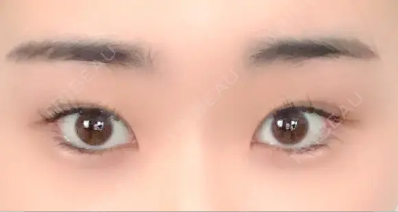 目尻切開 / タレ目形成・グラマラスライン（埋没） LOUIS CLINIC 二子玉川院【ルイクリニック】 DAY 8 メイン用