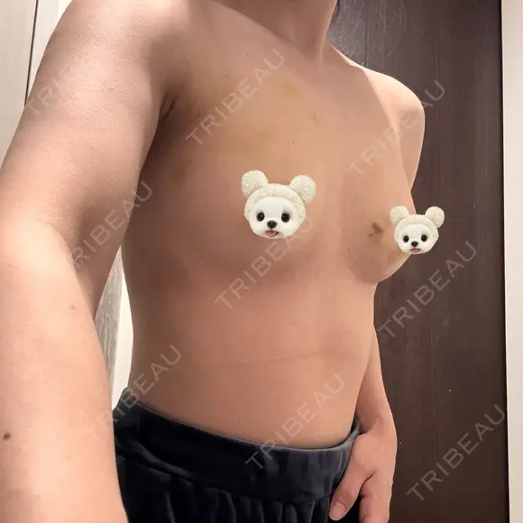 豊胸（脂肪注入） 銀座マイアミ美容外科 DAY 7 メイン用