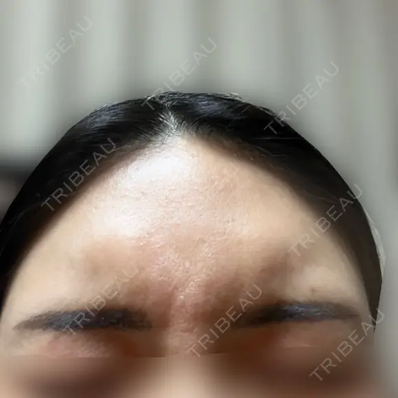 ボトックス（眉間） / ボトックス（額） MAクリニック 心斎橋 DAY 0 メイン用