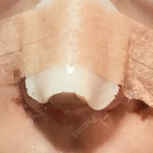 鼻尖形成（切開） / 小鼻縮小（切開） / 眉間プロテーゼ 東京シンデレラ美容外科 池袋院 DAY 2 メイン用