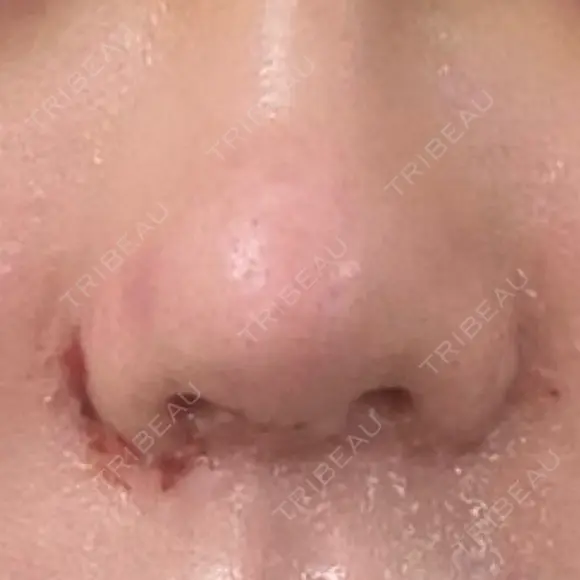 鼻尖形成（切開） / 小鼻縮小（切開） / 眉間プロテーゼ 東京シンデレラ美容外科 池袋院 DAY 7 メイン用