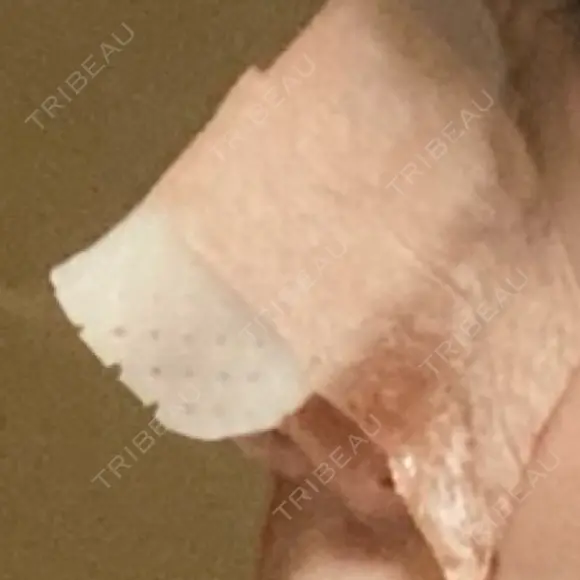 鼻尖形成（切開） / 小鼻縮小（切開） / 眉間プロテーゼ 東京シンデレラ美容外科 池袋院 DAY 2 メイン用