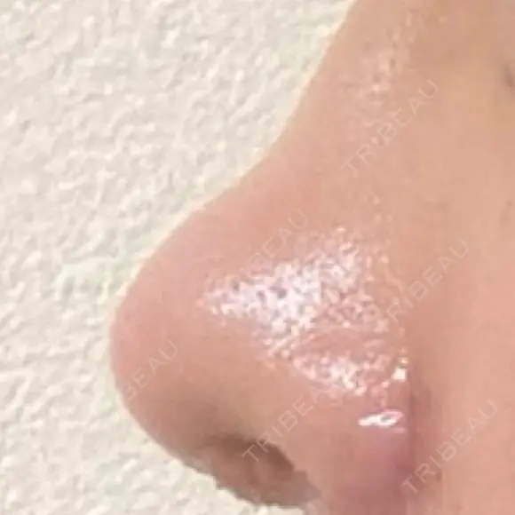 鼻尖形成（切開） / 小鼻縮小（切開） / 眉間プロテーゼ 東京シンデレラ美容外科 池袋院 DAY 7 メイン用