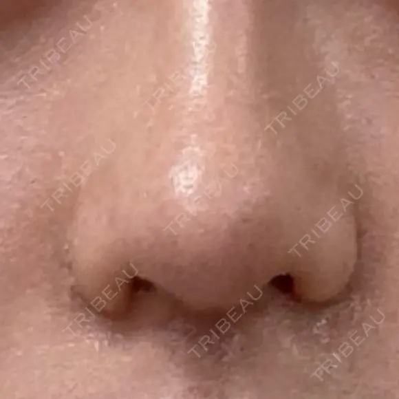 鼻尖形成（切開） / 小鼻縮小（切開） / 眉間プロテーゼ 東京シンデレラ美容外科 池袋院 AFTER メイン用