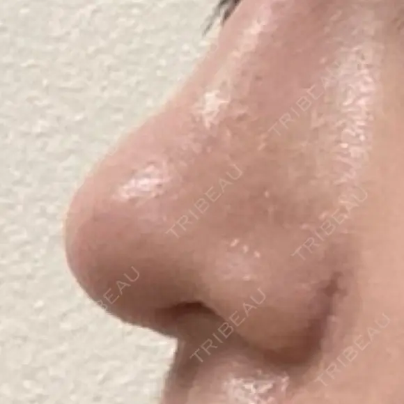 鼻尖形成（切開） / 小鼻縮小（切開） / 眉間プロテーゼ 東京シンデレラ美容外科 池袋院 DAY 29 メイン用