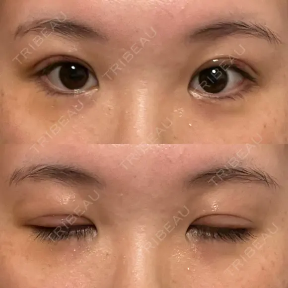 二重切開 / 眼瞼下垂（切開） / 上まぶたたるみ取り ユア美容クリニック 福岡院 DAY 7 メイン用