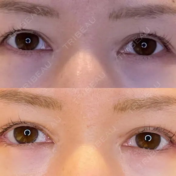 目尻切開 / タレ目形成・グラマラスライン（埋没） LOUIS CLINIC 二子玉川院【ルイクリニック】 DAY 7 メイン用