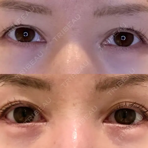 目尻切開 / タレ目形成・グラマラスライン（埋没） LOUIS CLINIC 二子玉川院【ルイクリニック】 DAY 9 メイン用