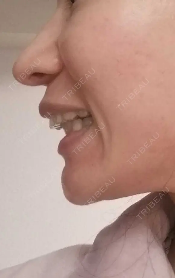 矯正（マウスピース） 銀座青山You矯正歯科 池袋西口医院 DAY 324 メイン用