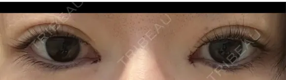 目頭切開 9BeautyClinic DAY 0 メイン用