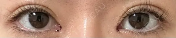 目頭切開 9BeautyClinic DAY 1 メイン用