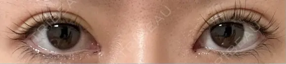 目頭切開 9BeautyClinic DAY 2 メイン用