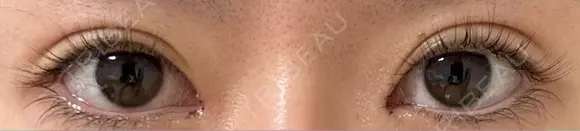 目頭切開 9BeautyClinic DAY 3 メイン用