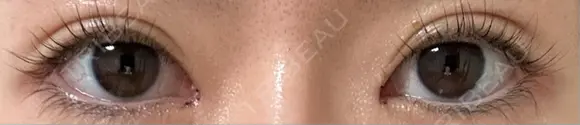 目頭切開 9BeautyClinic DAY 4 メイン用