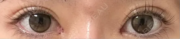 目頭切開 9BeautyClinic DAY 5 メイン用