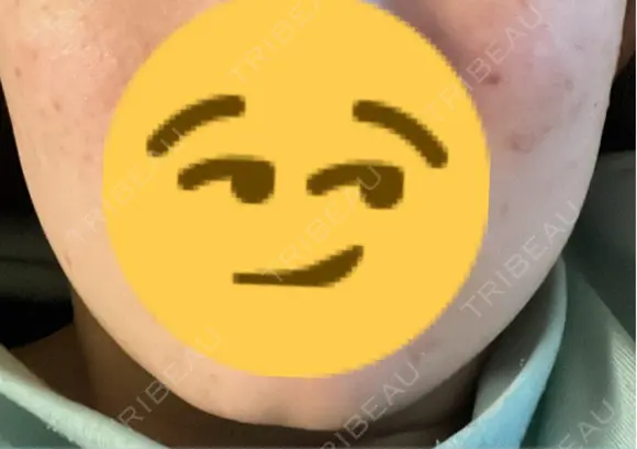 ボトックス（あご） ルラ美容クリニック 新宿院 AFTER メイン用