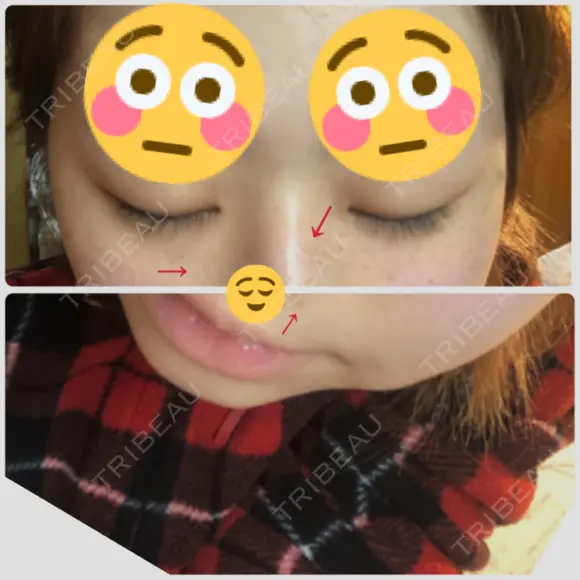 シミ取りレーザー / YAGレーザー 新宿Sクリニック AFTER メイン用