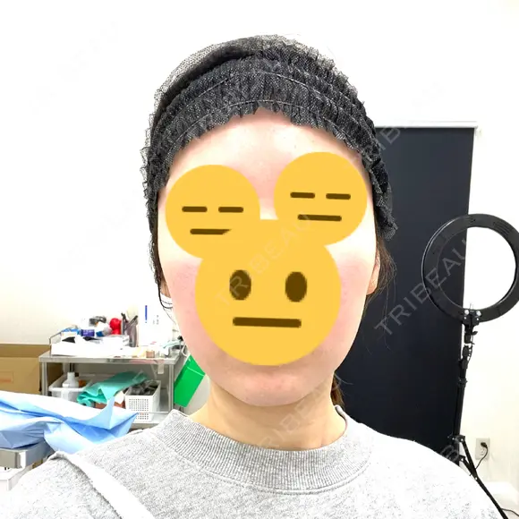RF（高周波）たるみ治療 MEMOTO CLINIC 名古屋 DAY 4 メイン用
